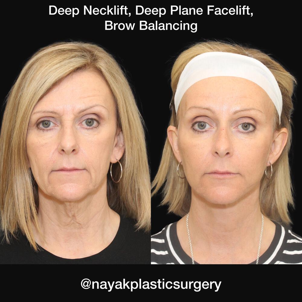 Deep Necklift Before & After Image