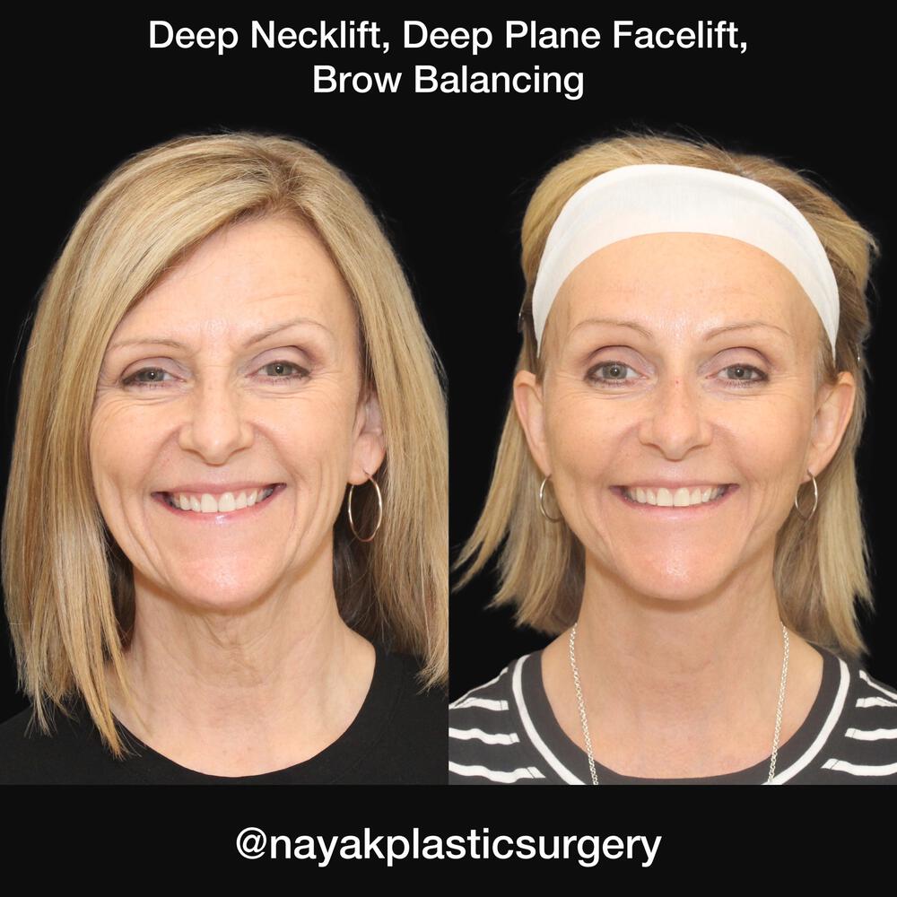 Deep Necklift Before & After Image