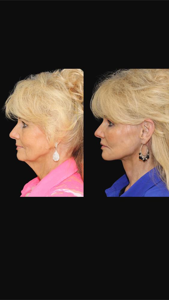 Deep Necklift Before & After Image