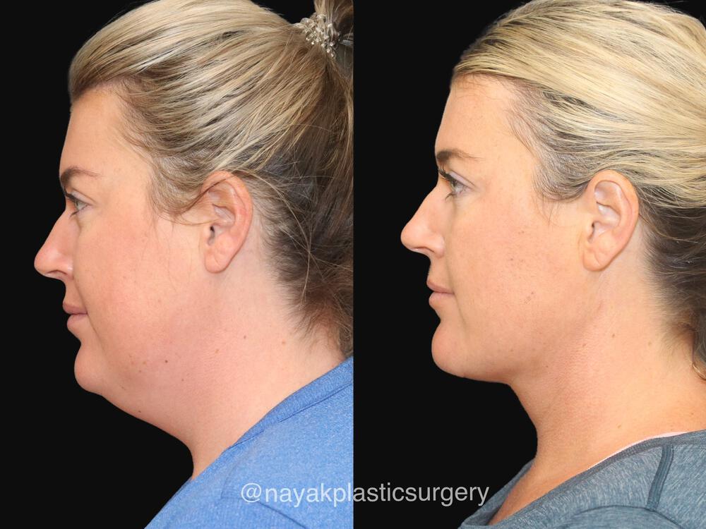 Deep Necklift Before & After Image