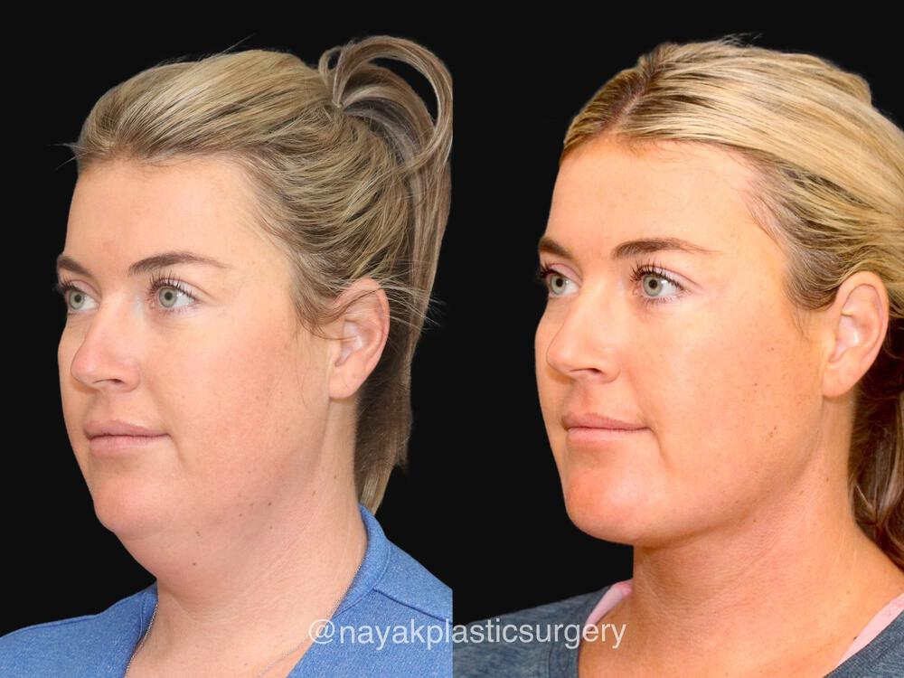 Deep Necklift Before & After Image