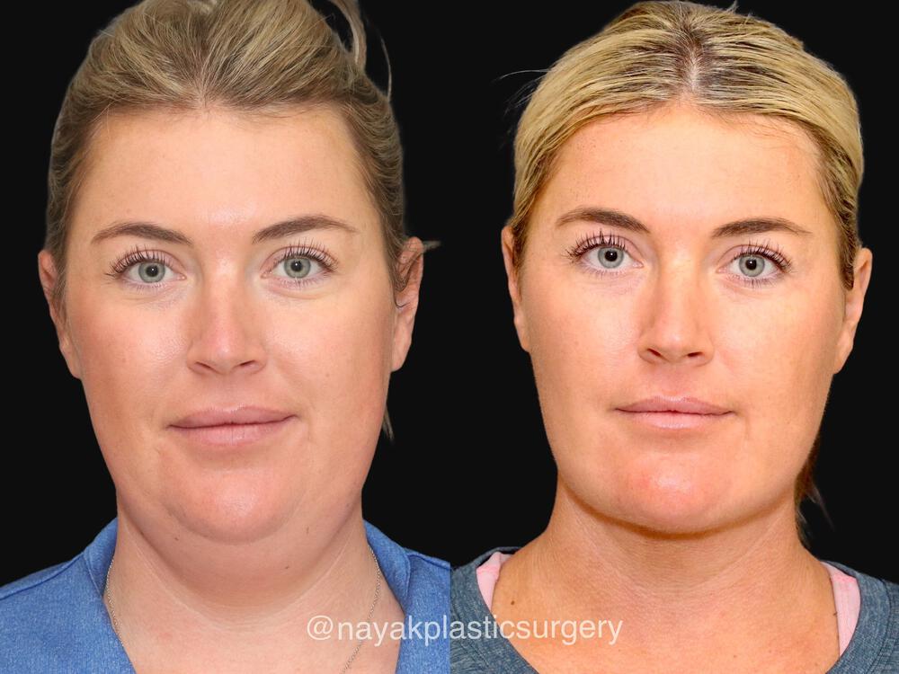 Deep Necklift Before & After Image