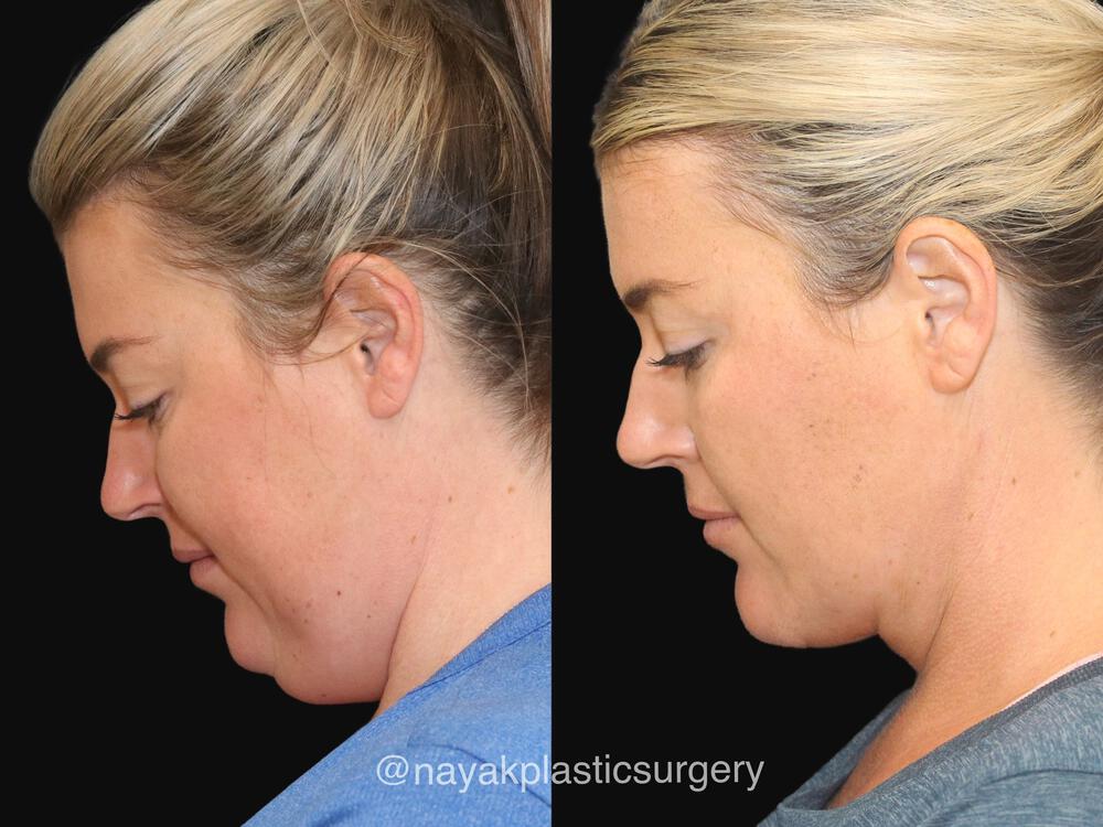 Deep Necklift Before & After Image