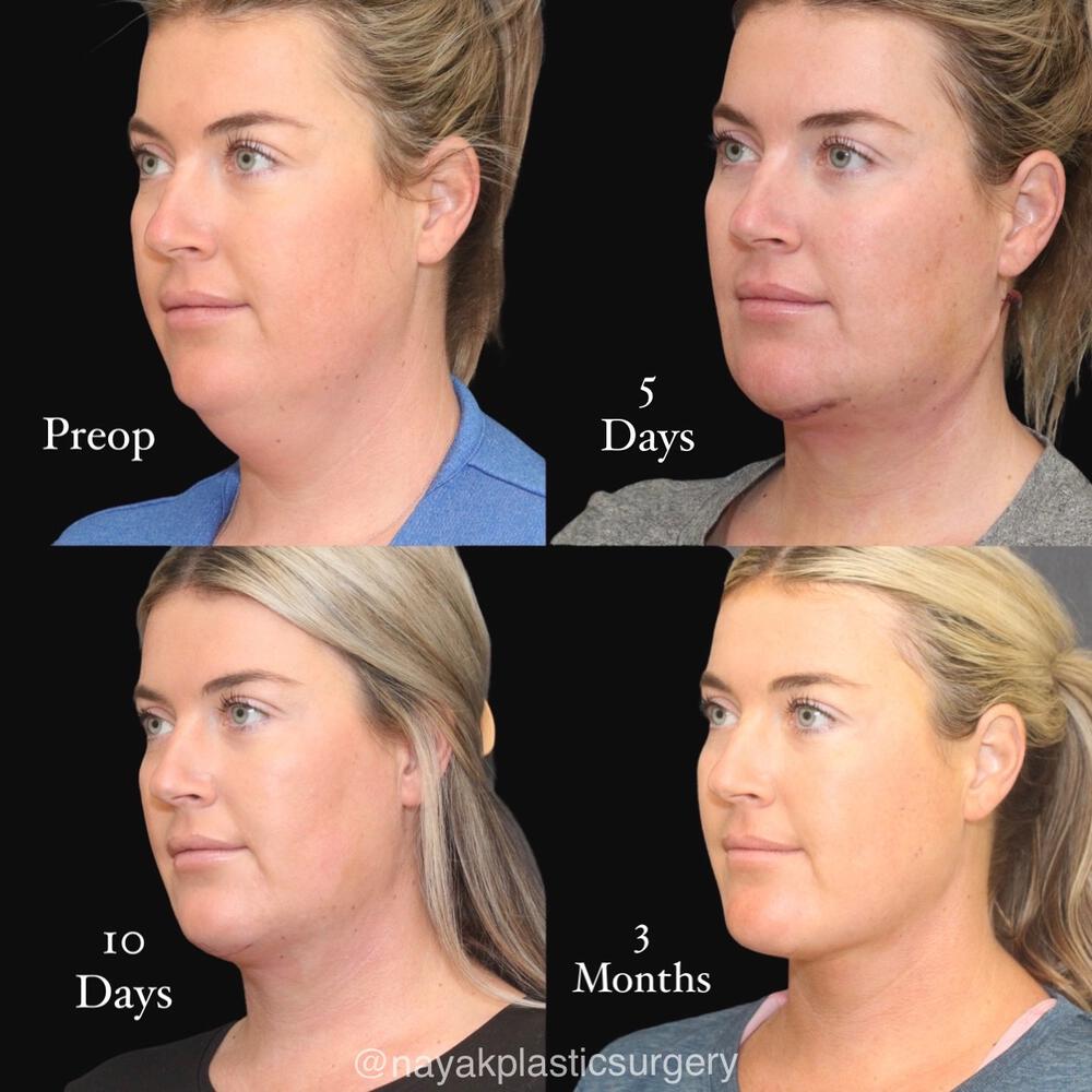 Deep Necklift Before & After Image