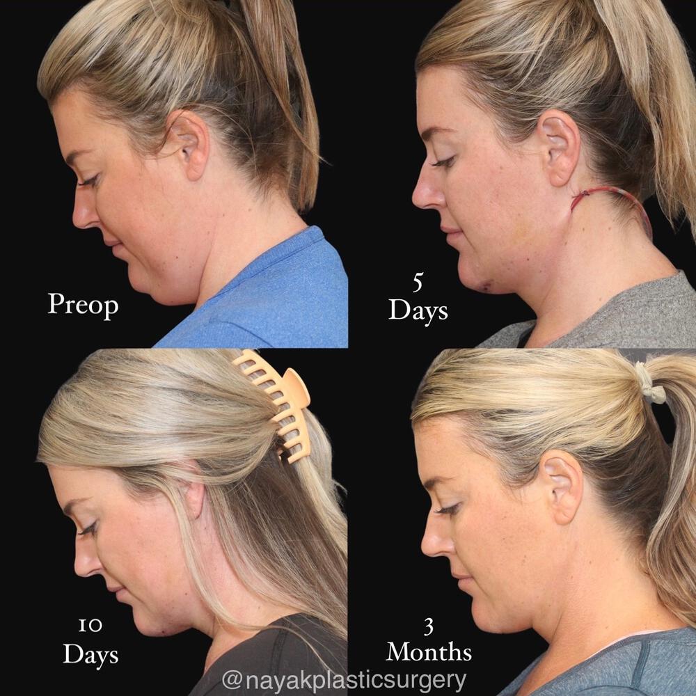 Deep Necklift Before & After Image