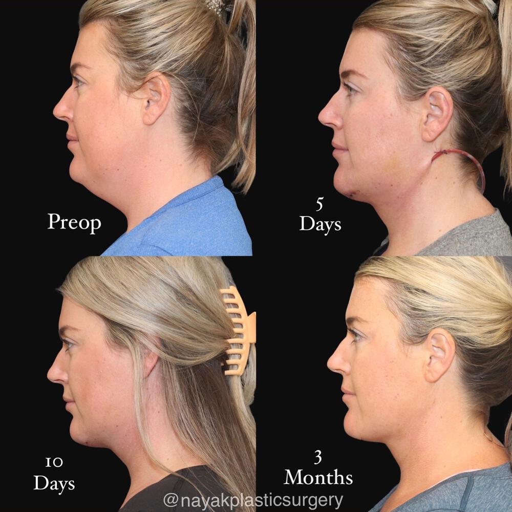 Deep Necklift Before & After Image