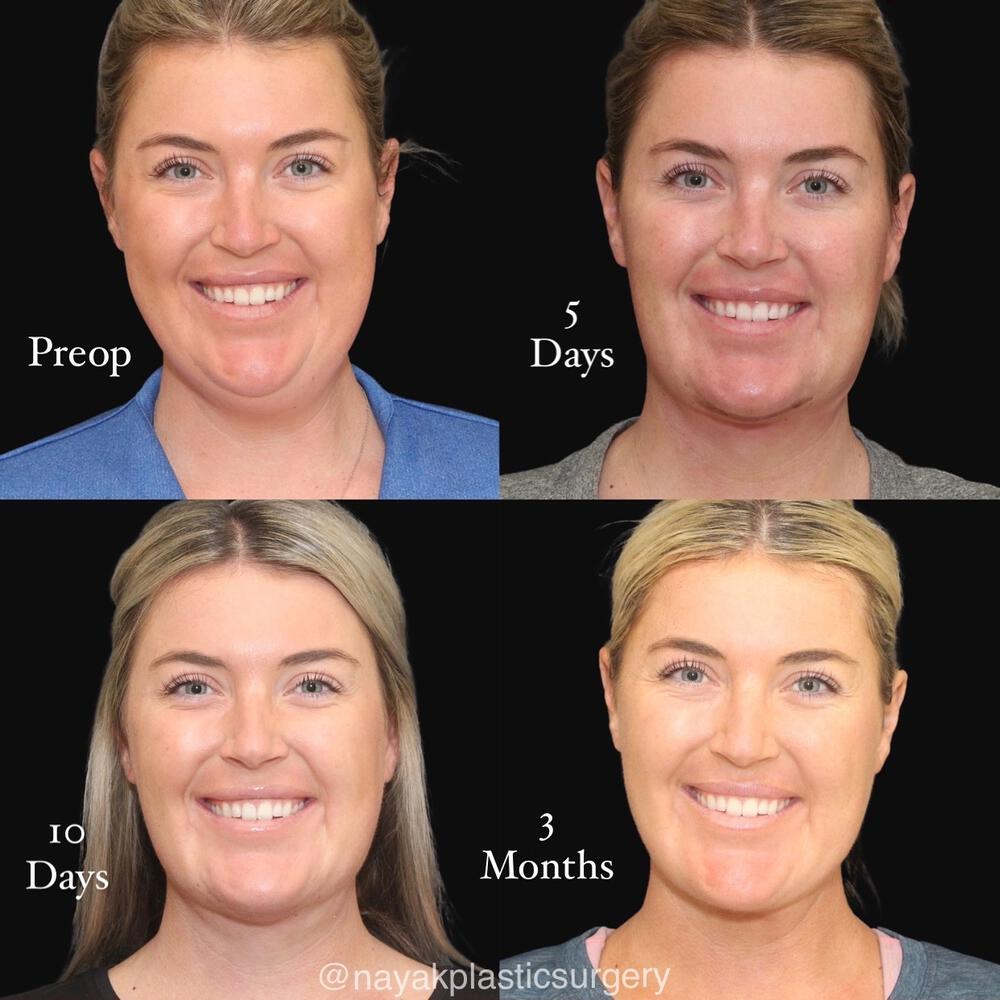 Deep Necklift Before & After Image