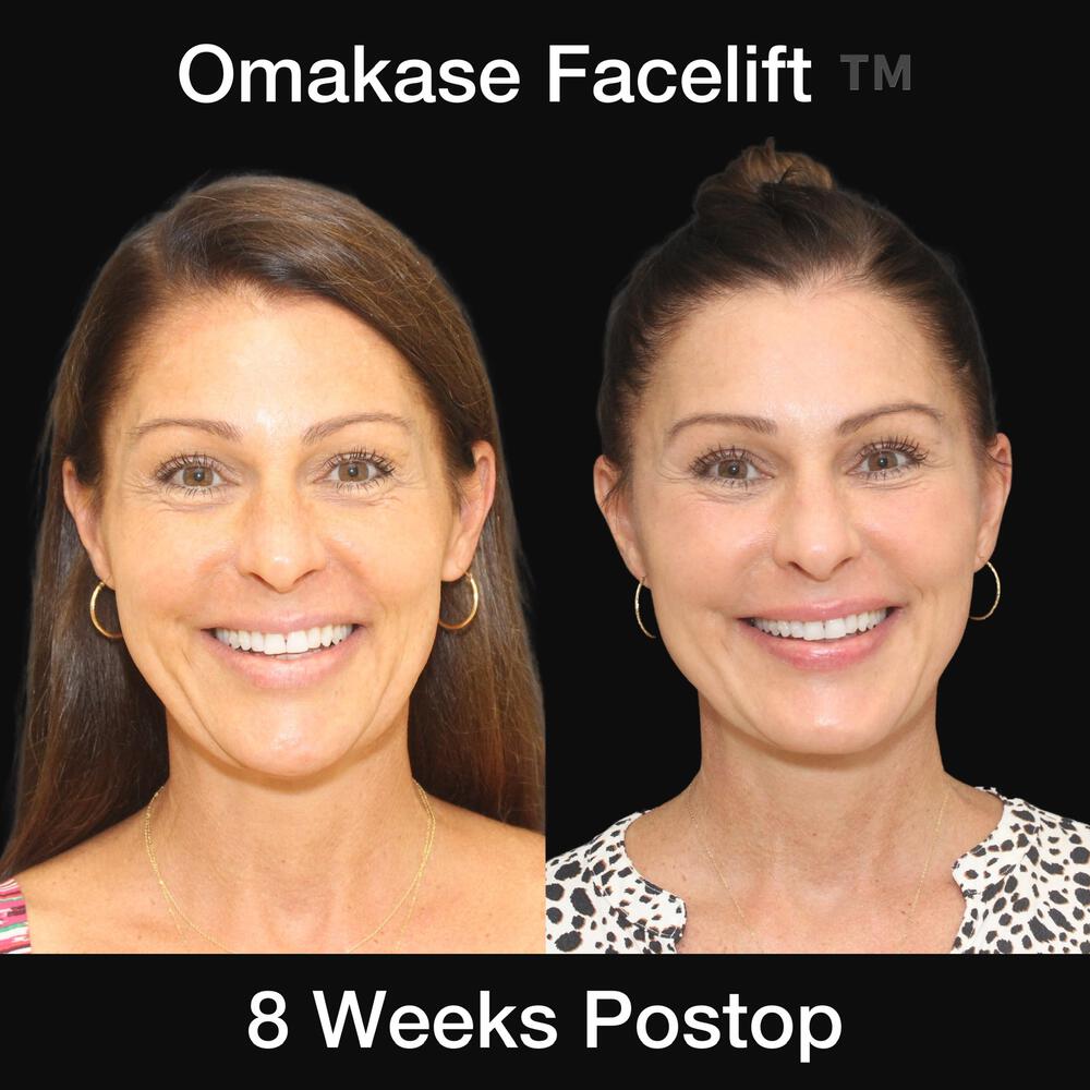 Deep Necklift Before & After Image