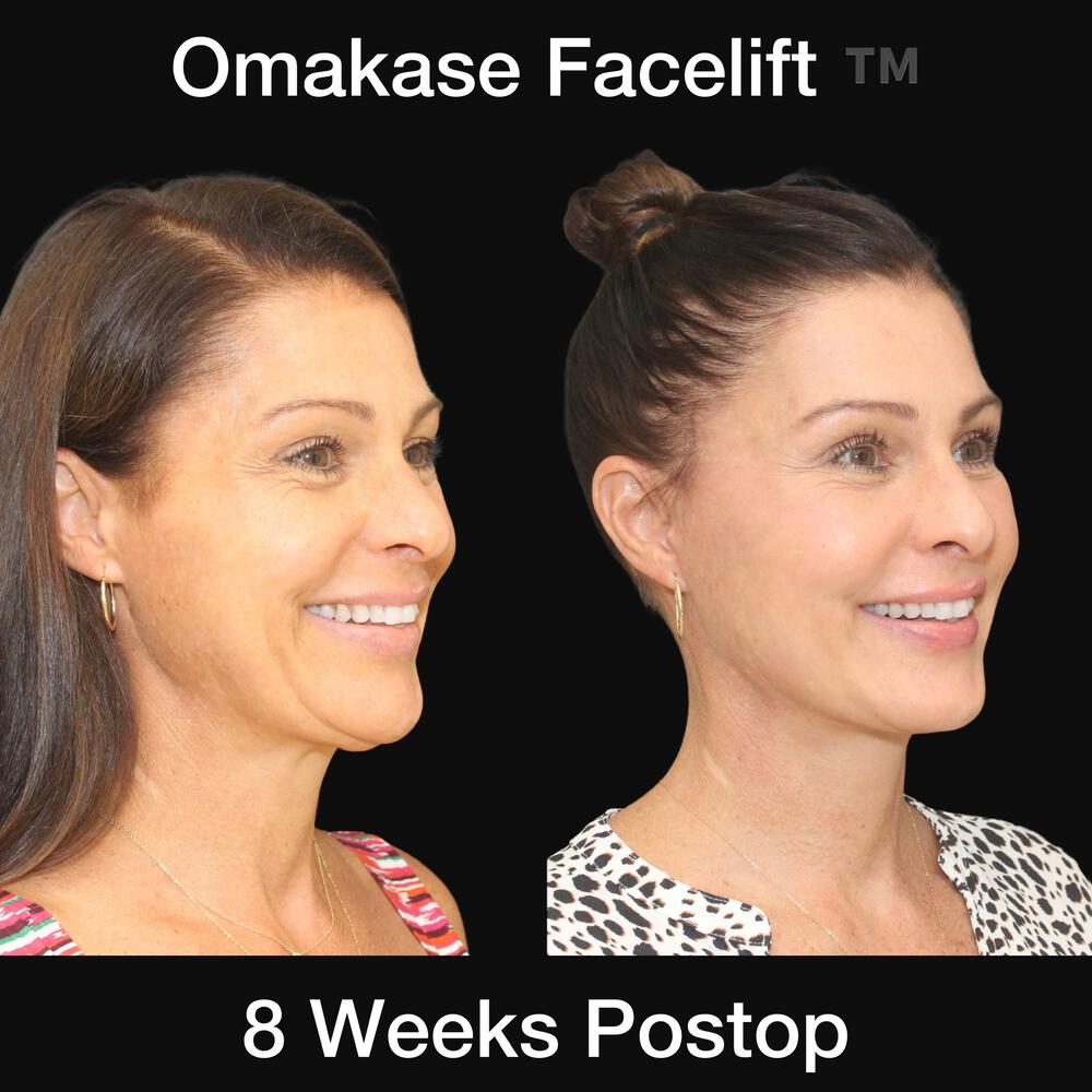 Deep Necklift Before & After Image