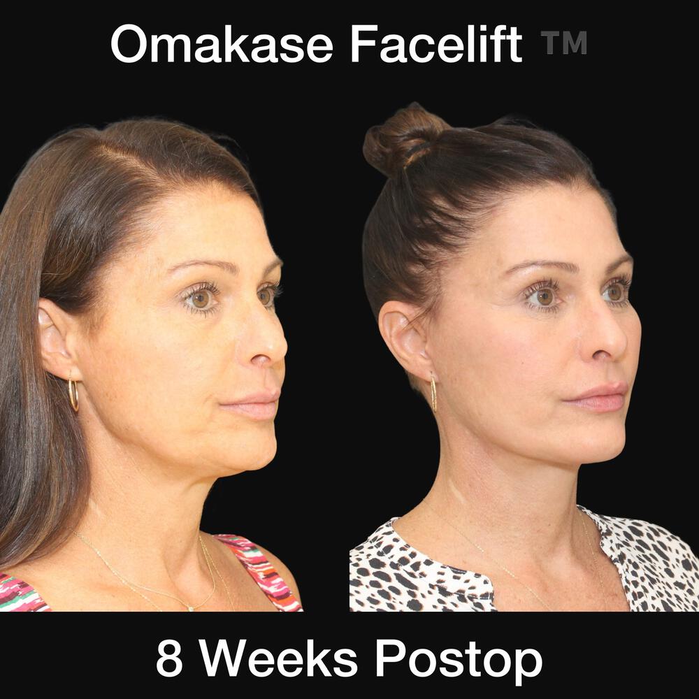 Deep Necklift Before & After Image