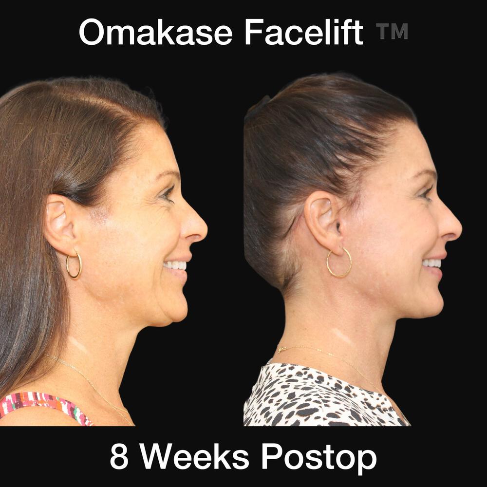 Deep Necklift Before & After Image