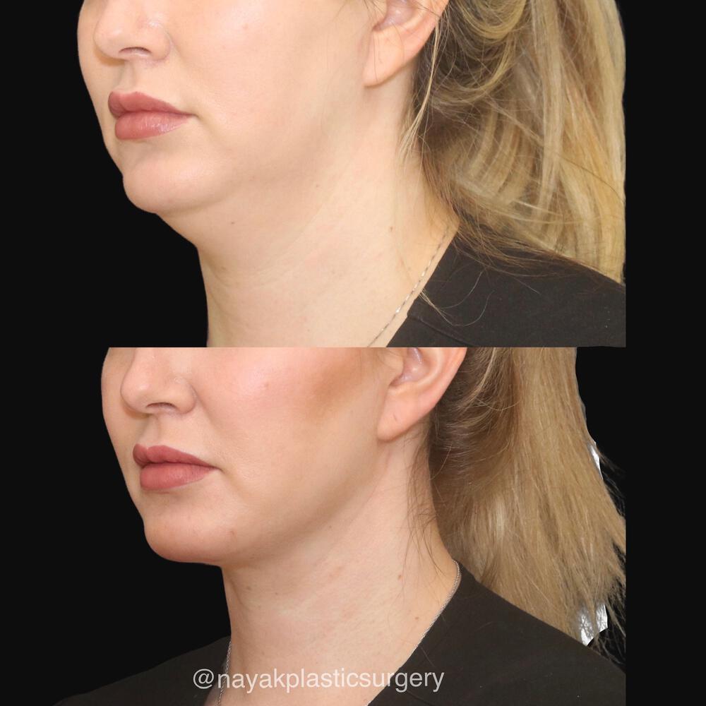 Deep Necklift Before & After Image