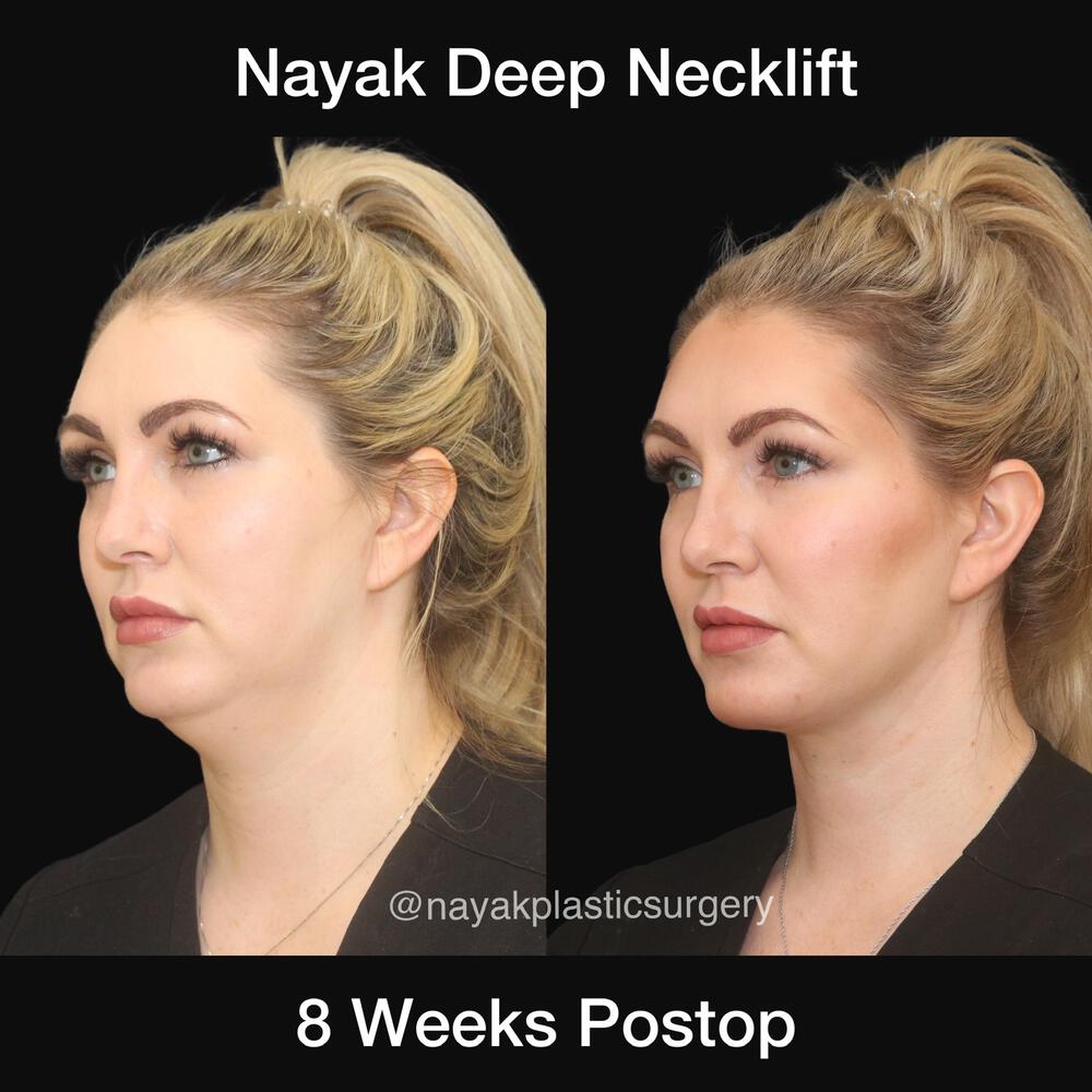 Deep Necklift Before & After Image