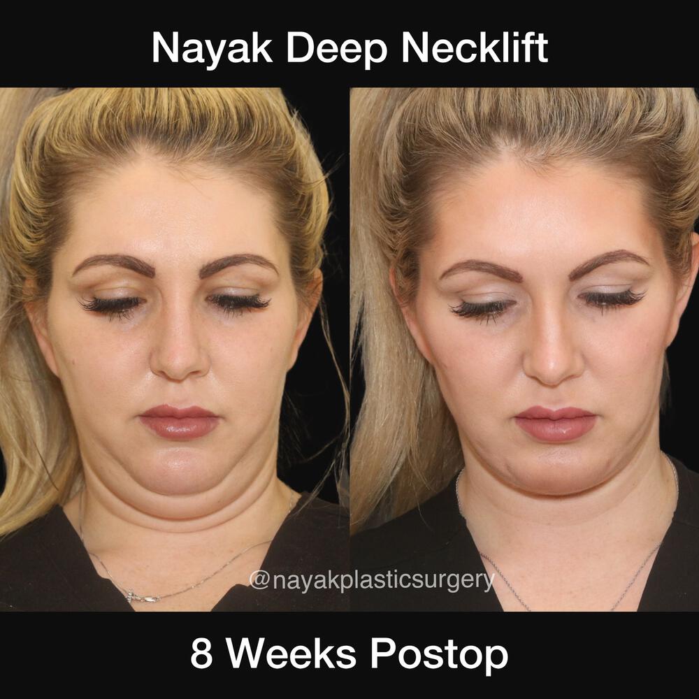 Deep Necklift Before & After Image
