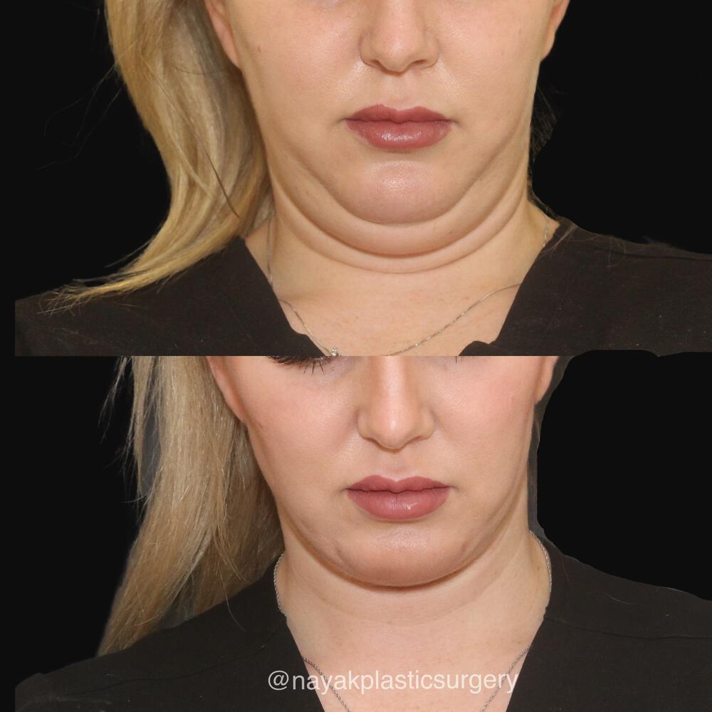 Deep Necklift Before & After Image