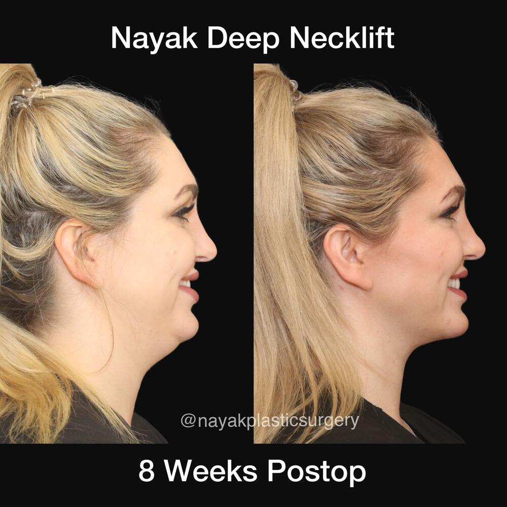 Deep Necklift Before & After Image