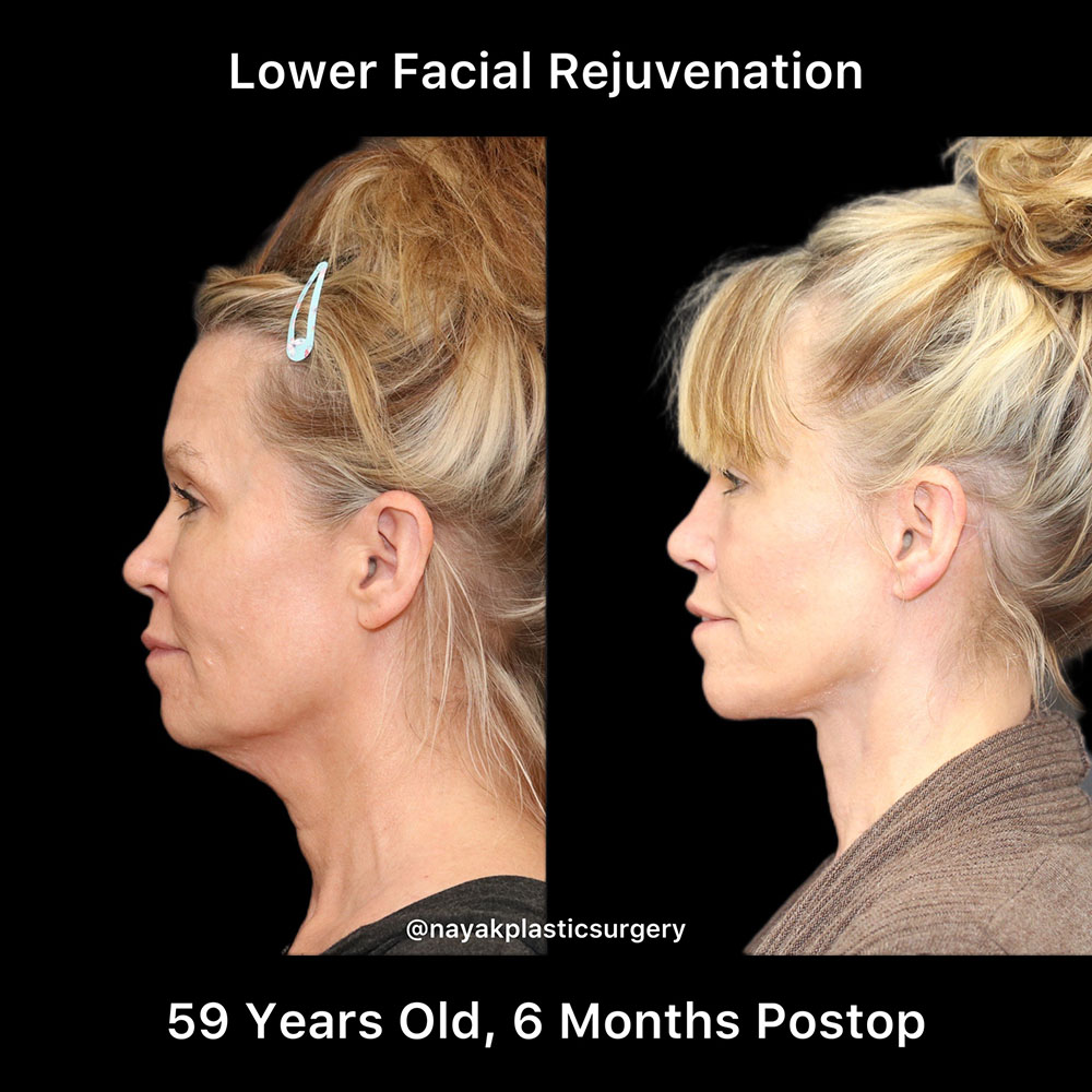 Deep Necklift Before & After Image