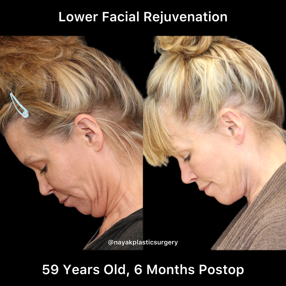 Deep Necklift Before & After Image