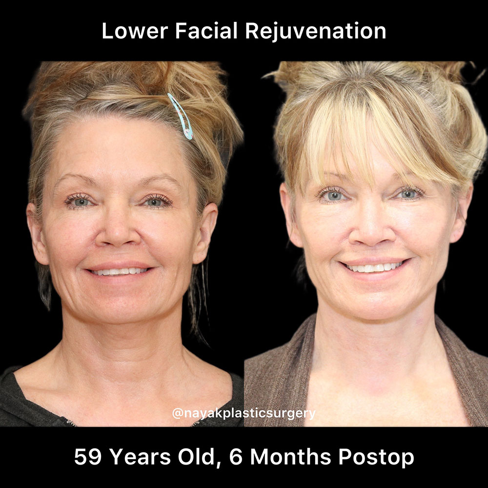 Deep Necklift Before & After Image