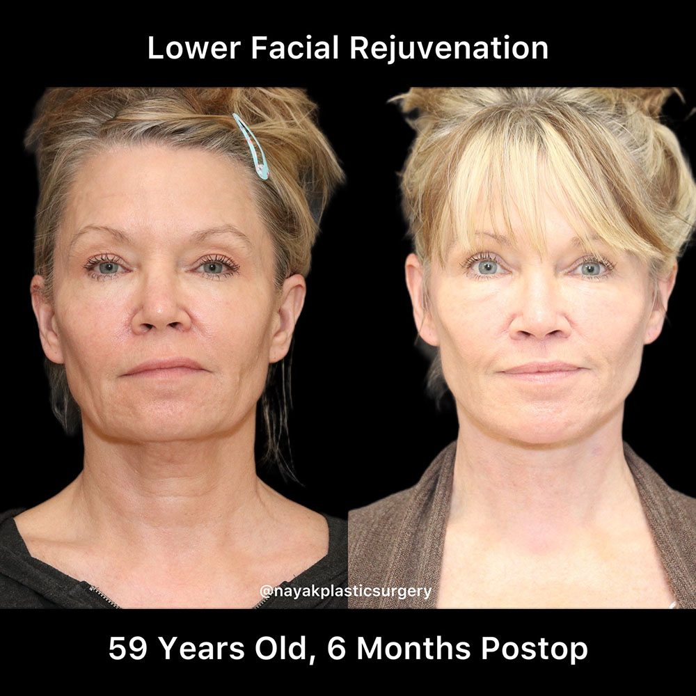 Deep Necklift Before & After Image