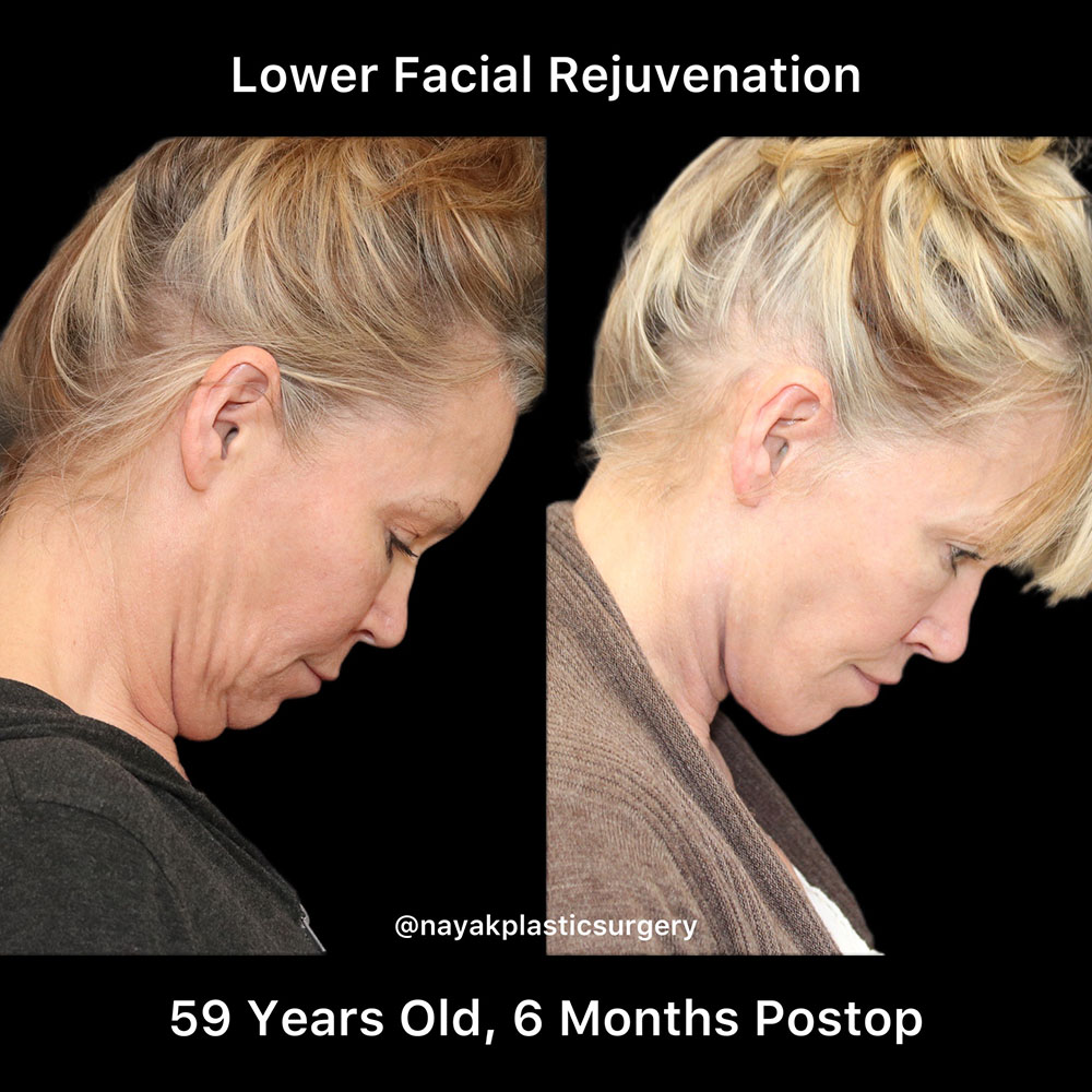 Deep Necklift Before & After Image