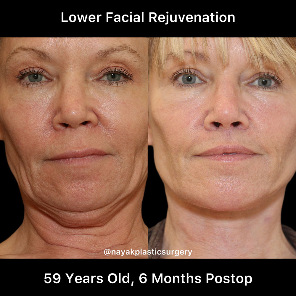 Deep Necklift Before & After Image