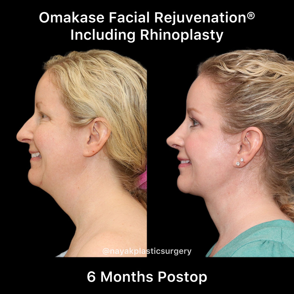 Deep Necklift Before & After Image