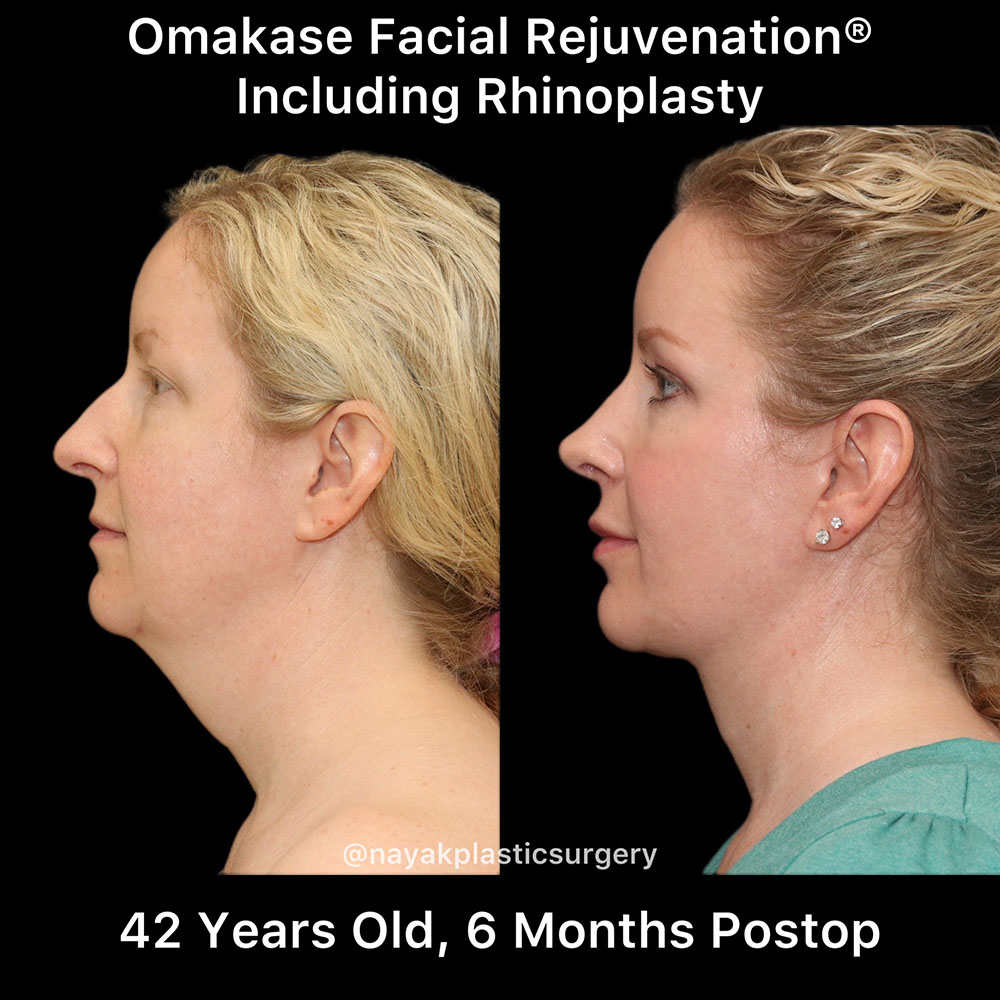 Deep Necklift Before & After Image