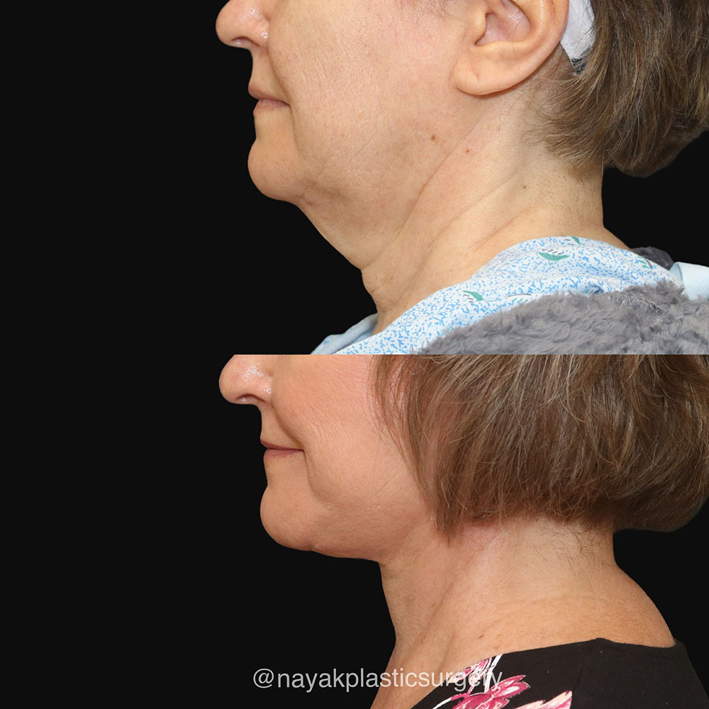 Deep Necklift Before & After Image