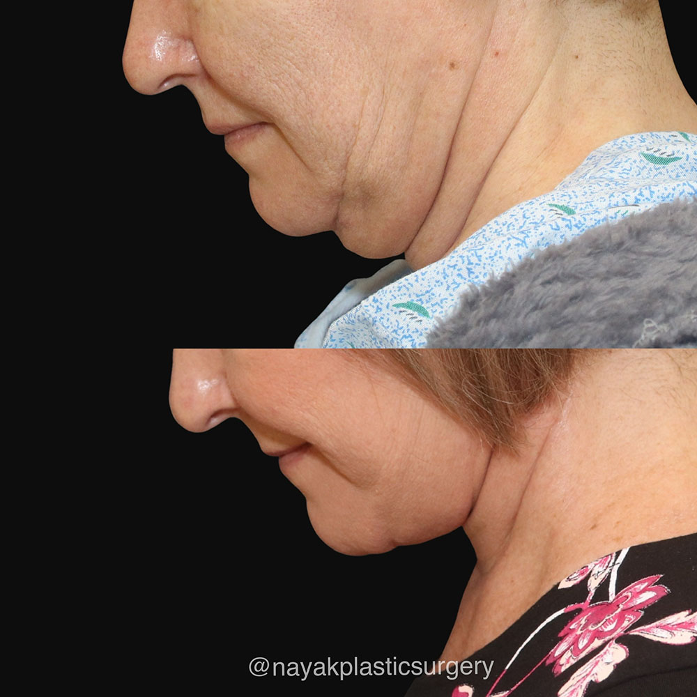 Deep Necklift Before & After Image