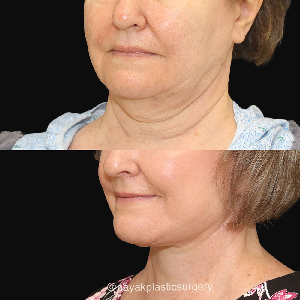 Deep Necklift Before & After Image