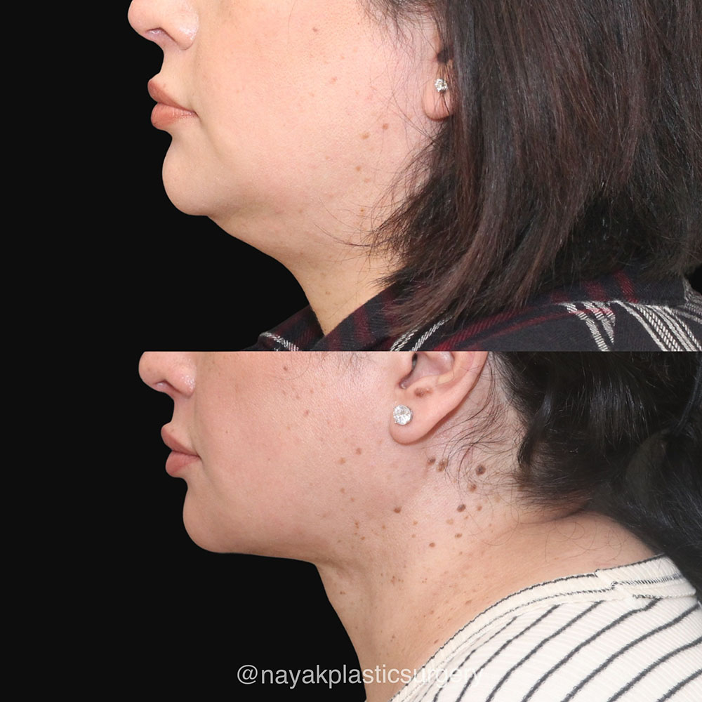 Deep Necklift Before & After Image