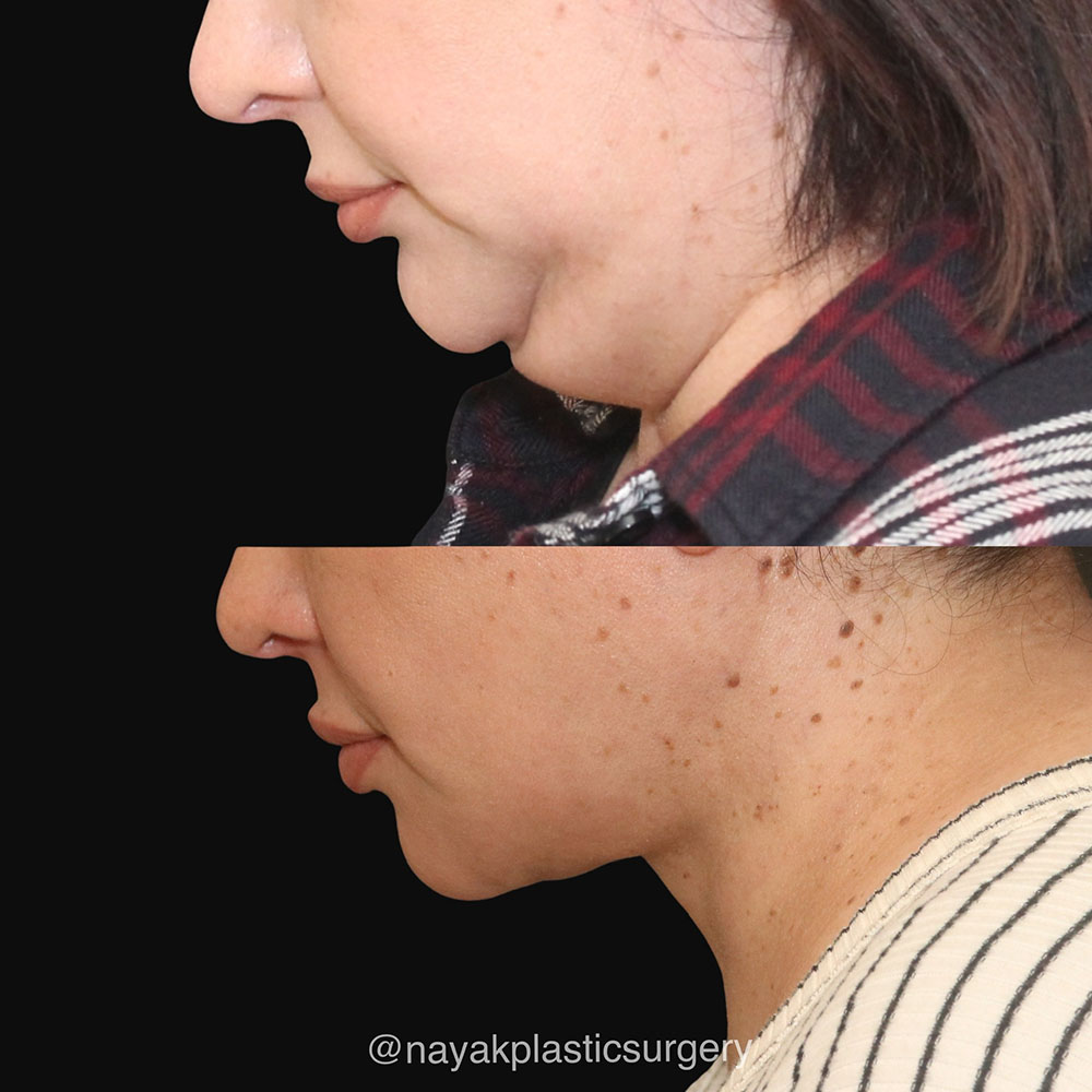 Deep Necklift Before & After Image