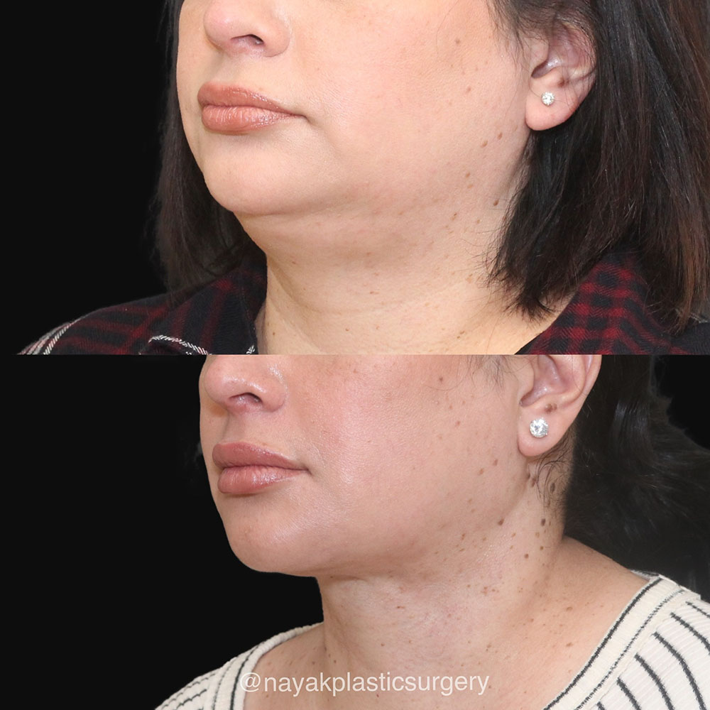 Deep Necklift Before & After Image