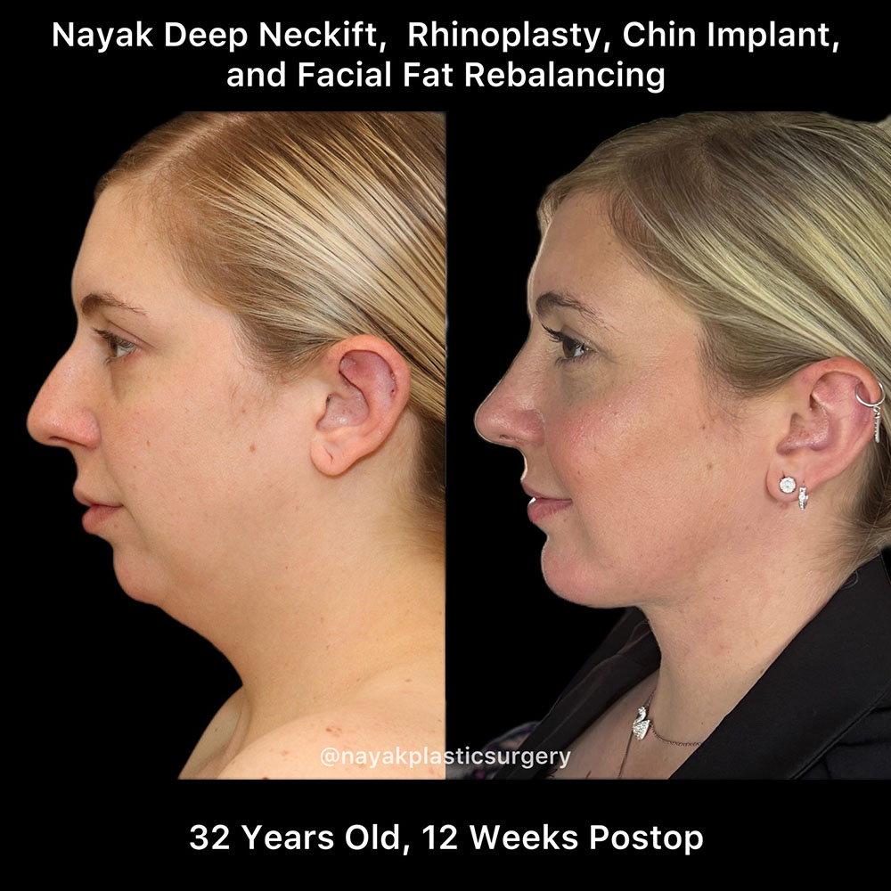 Deep Necklift Before & After Image