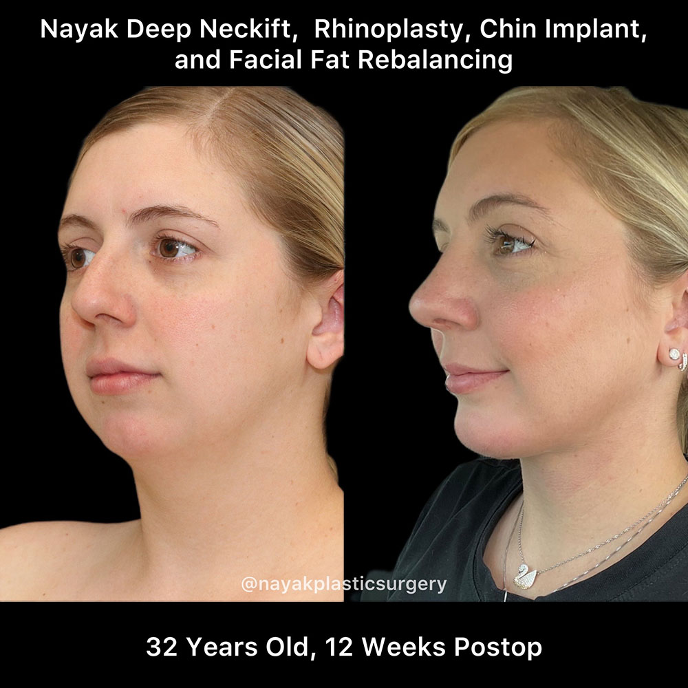 Deep Necklift Before & After Image