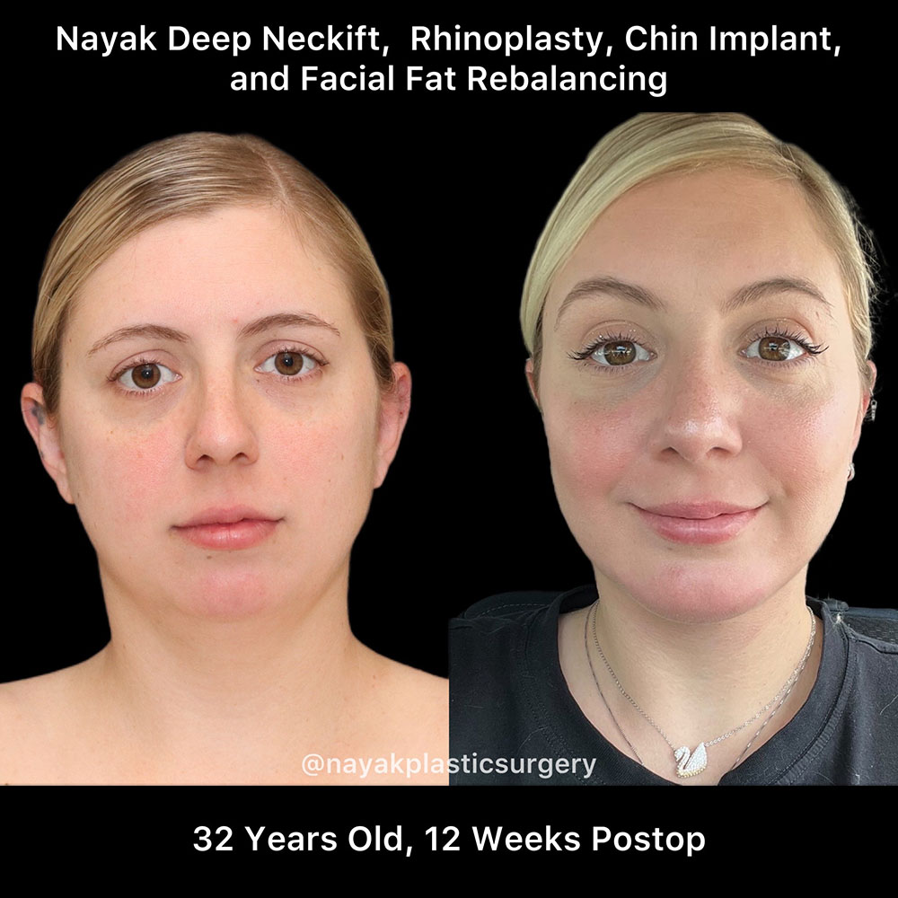 Deep Necklift Before & After Image