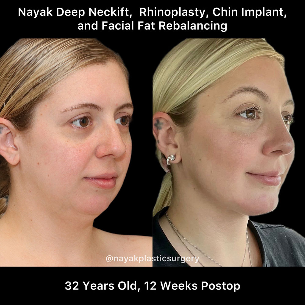 Deep Necklift Before & After Image