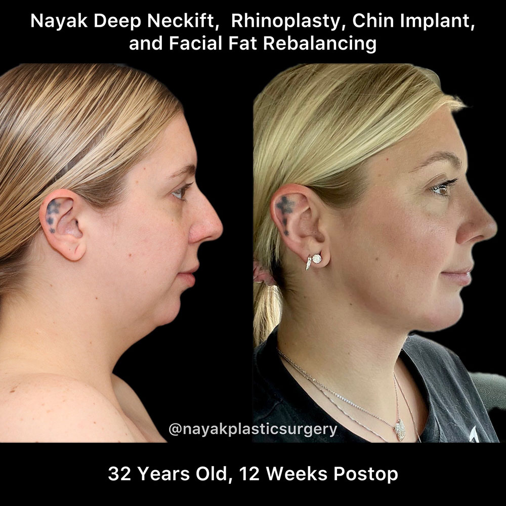 Deep Necklift Before & After Image