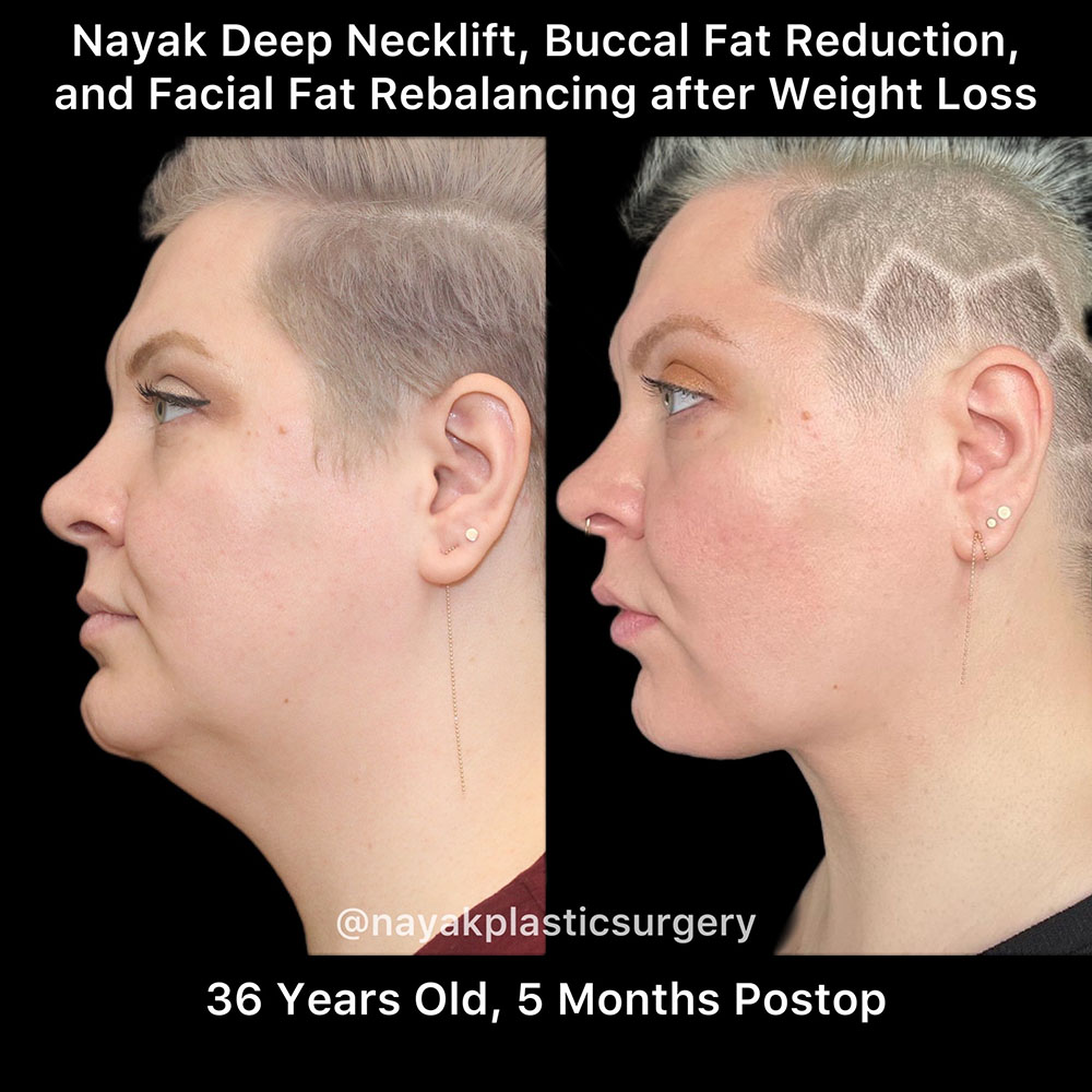 Deep Necklift Before & After Image