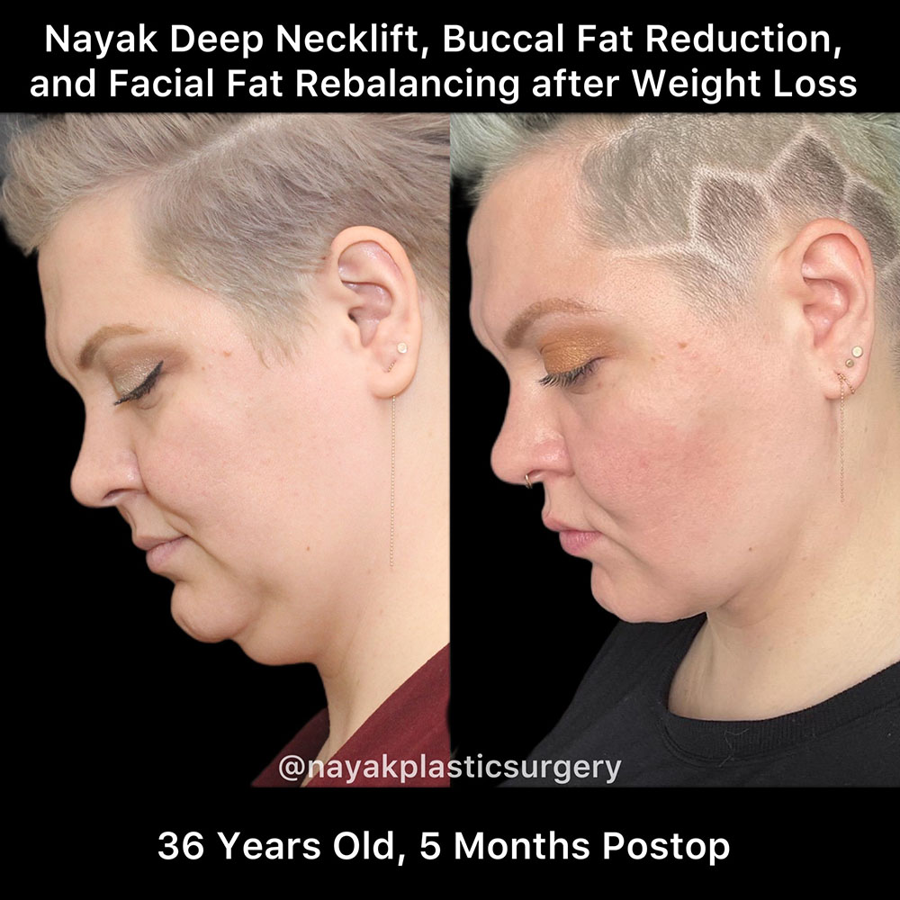 Deep Necklift Before & After Image