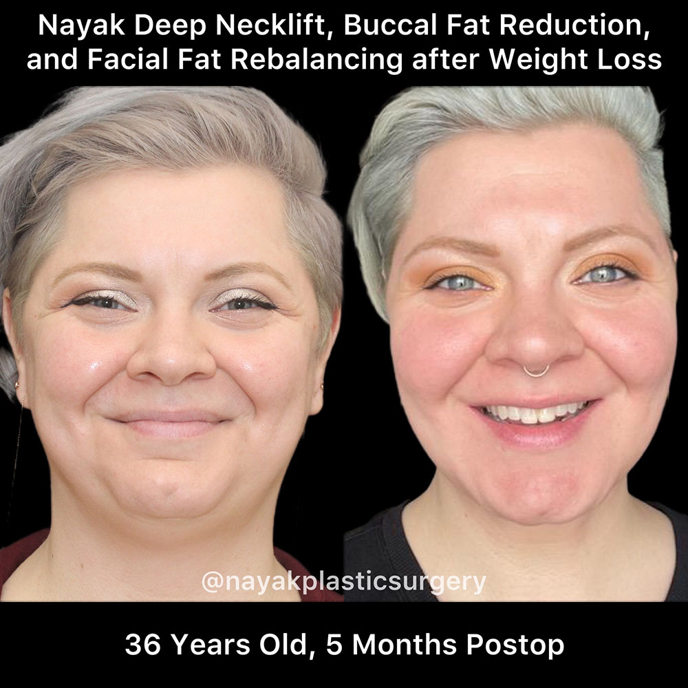 Deep Necklift Before & After Image