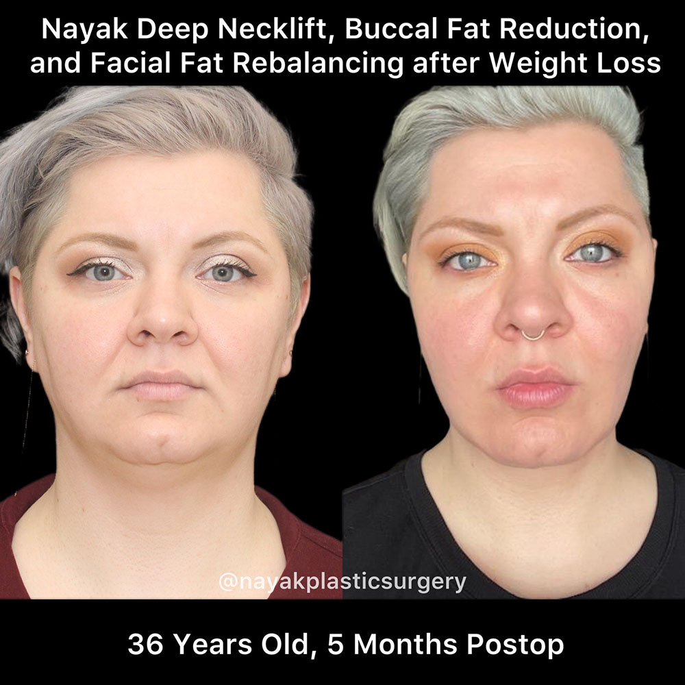 Deep Necklift Before & After Image