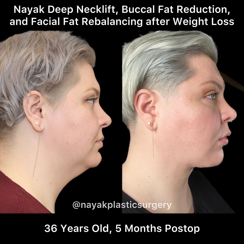 Deep Necklift Before & After Image