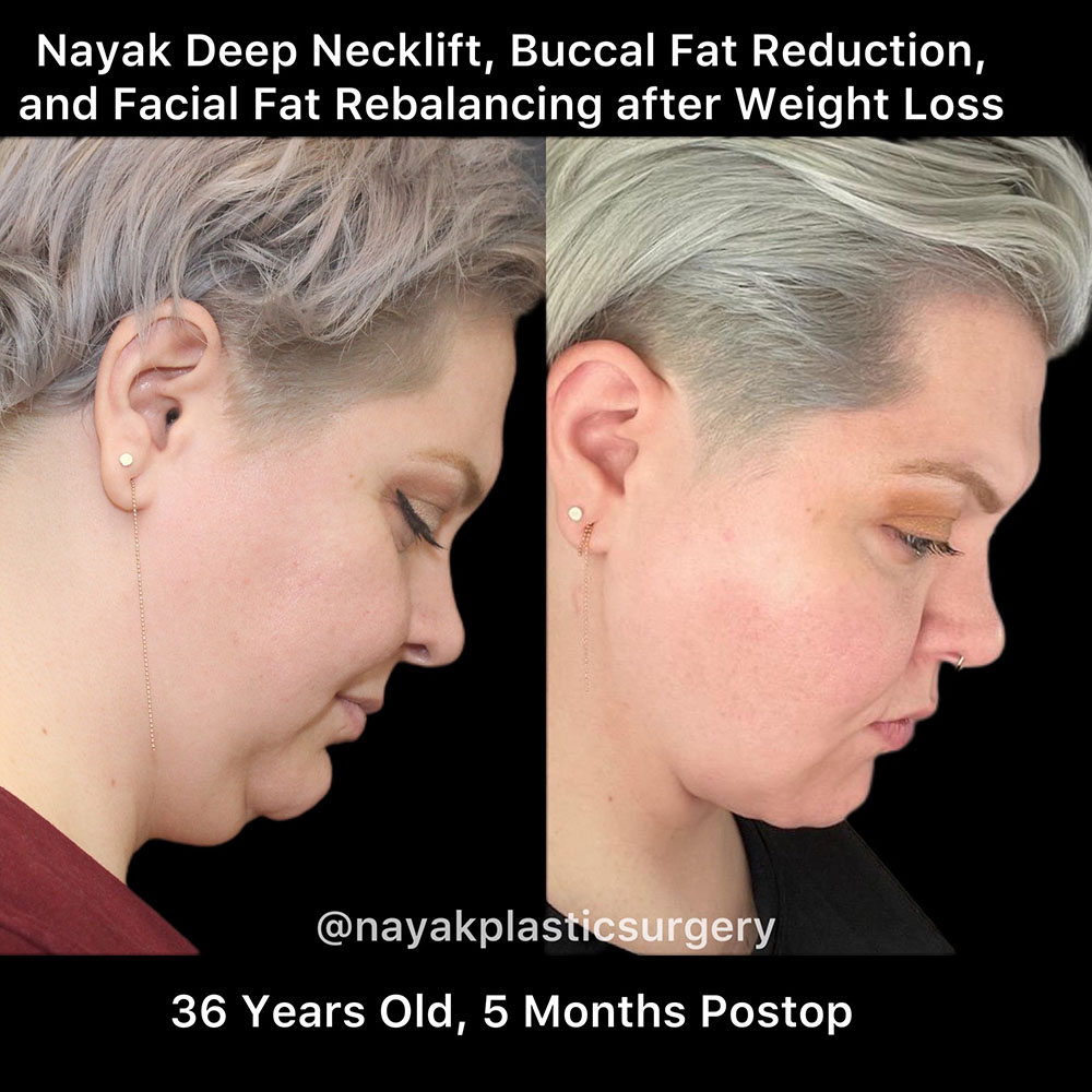 Deep Necklift Before & After Image