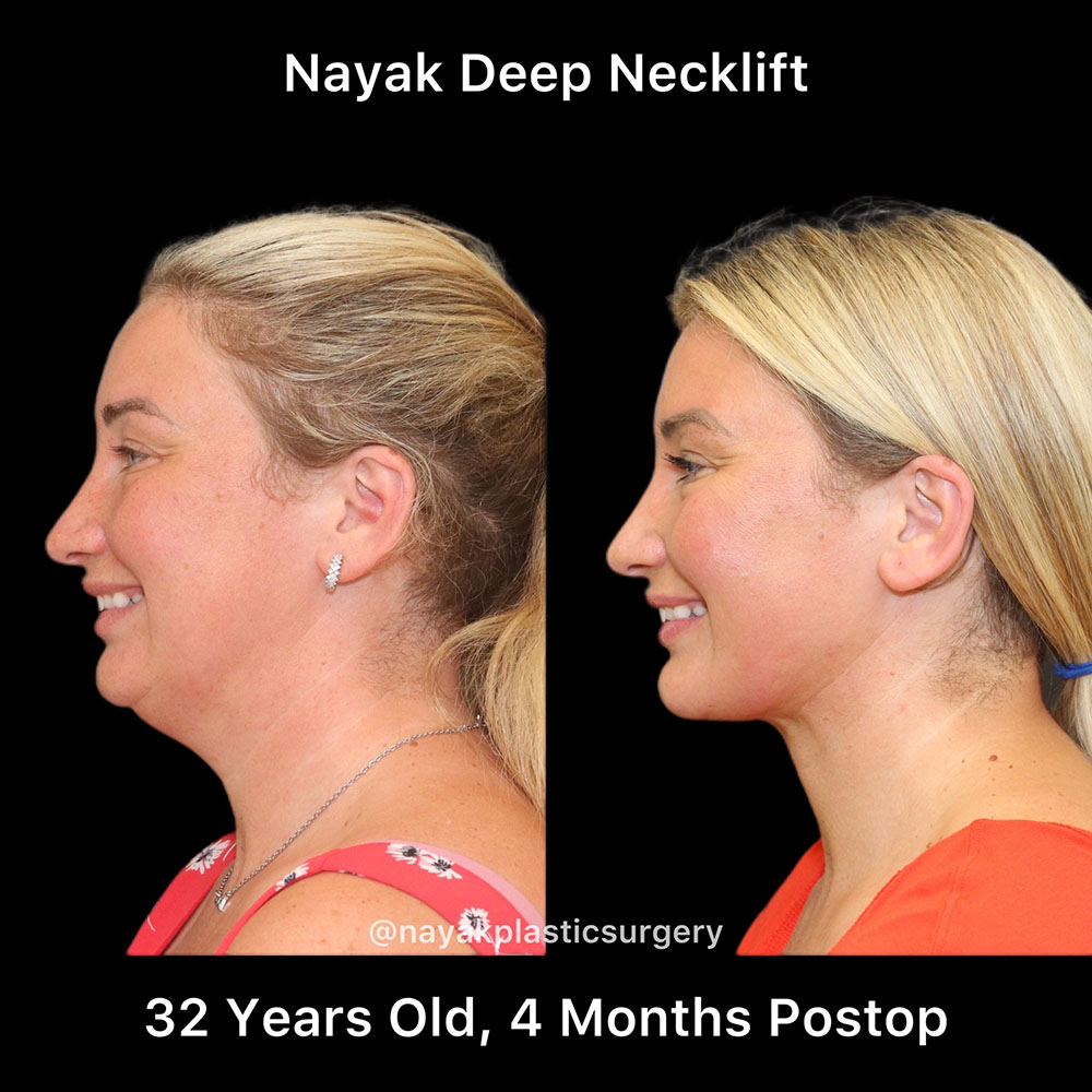 Deep Necklift Before & After Image