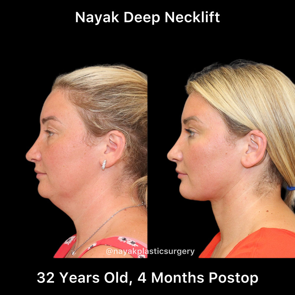 Deep Necklift Before & After Image