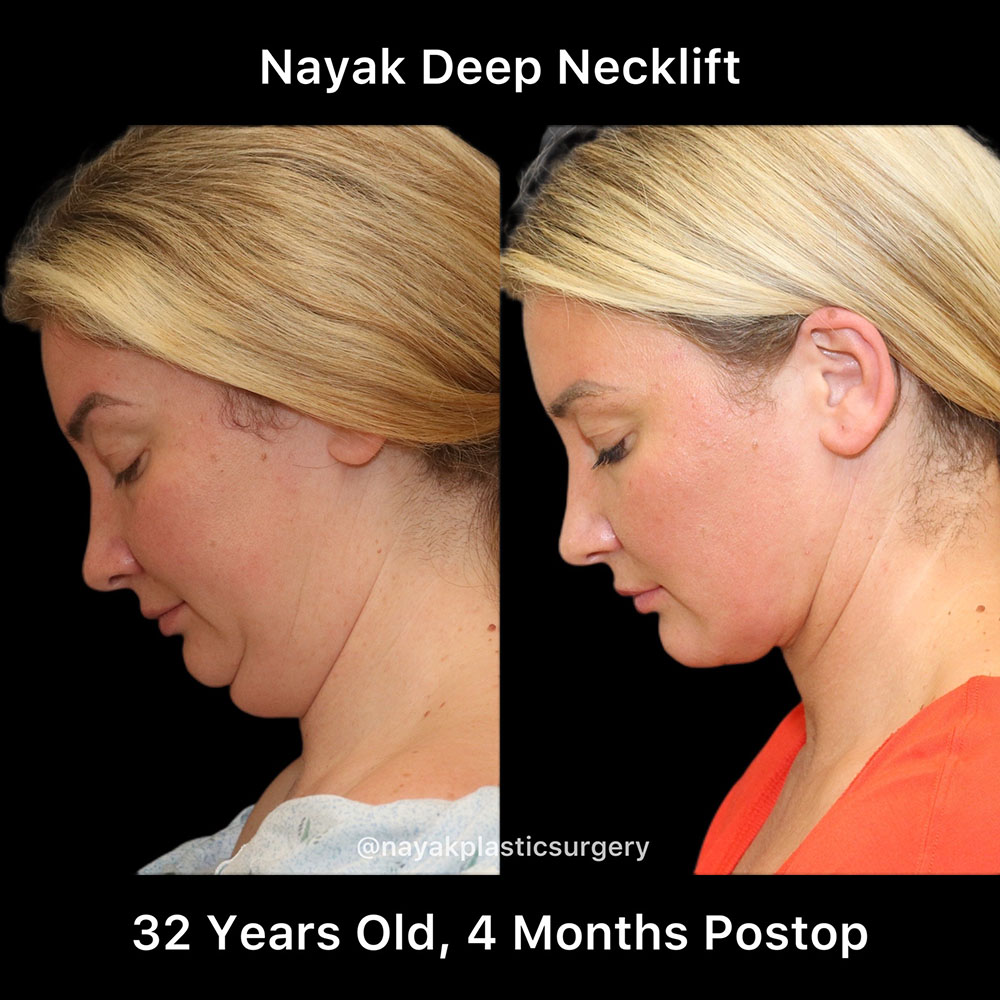 Deep Necklift Before & After Image