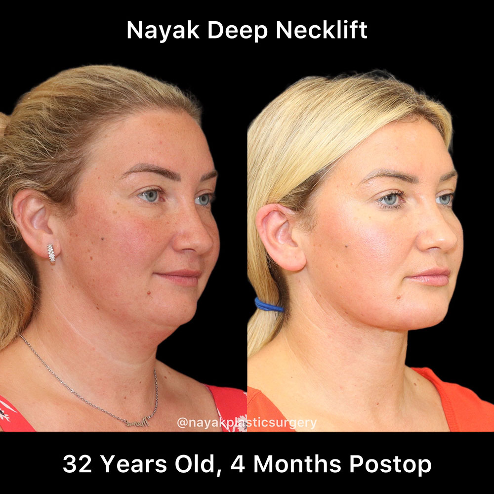 Deep Necklift Before & After Image