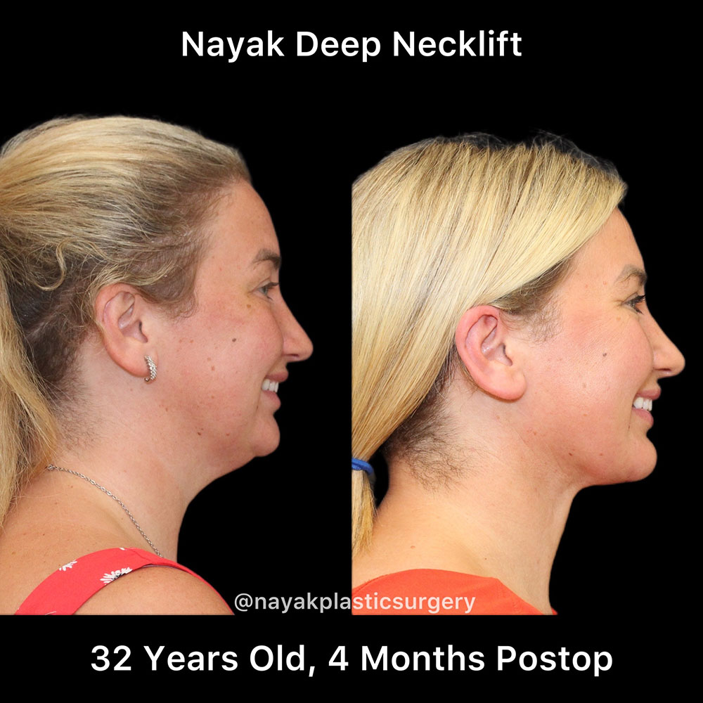 Deep Necklift Before & After Image